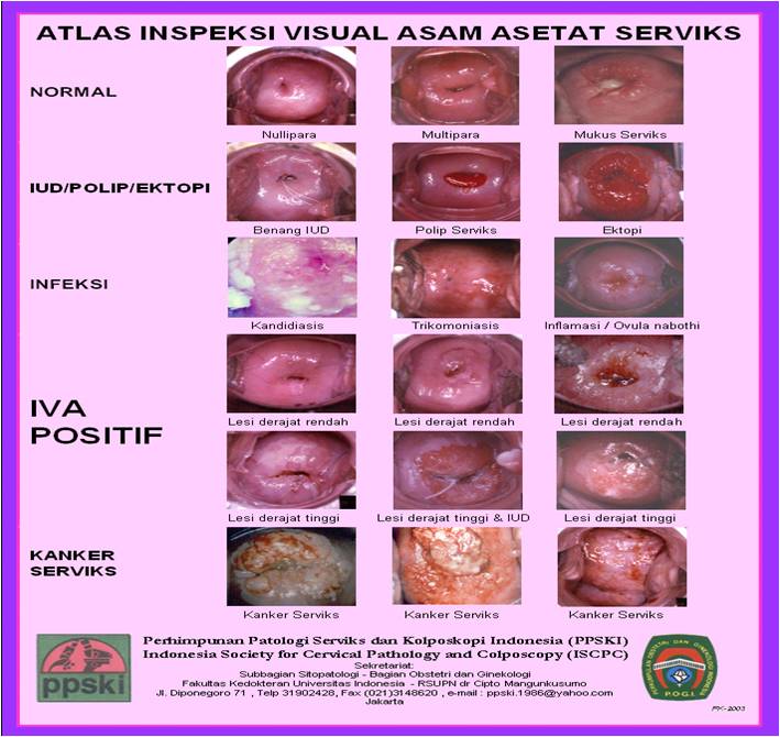 » Skrining Kanker Serviks Dengan Metoda Inspeksi Visual Dengan Asam